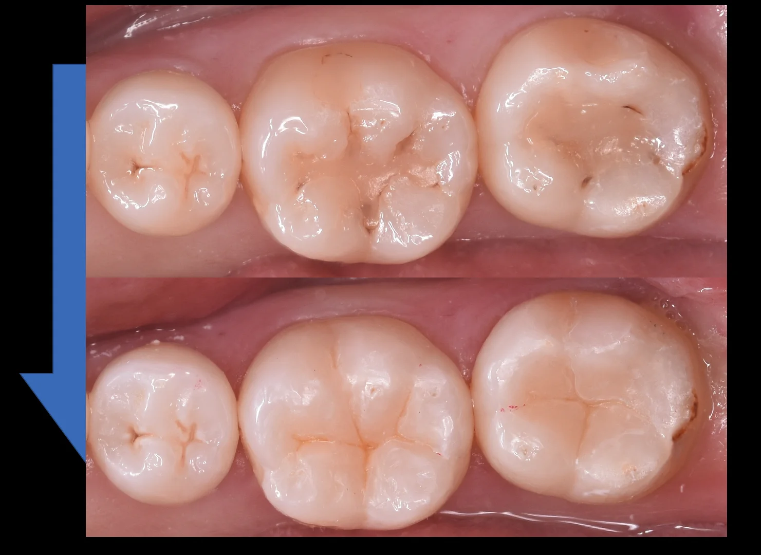 他県にて勤務中の歯科衛生士の方の治療。|坂寄歯科医院(取手市藤代) - 画像5