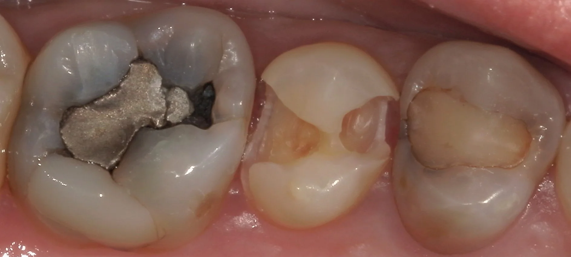 遠方から来院の方を白い詰め物にて治療。|坂寄歯科医院(取手市藤代) - 画像3