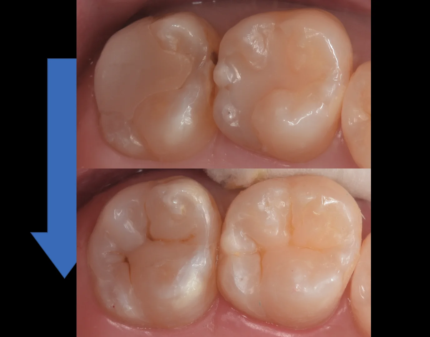 他院で入れたセラミックをダイレクトボンディングに。｜坂寄歯科医院（取手市藤代） - 画像5