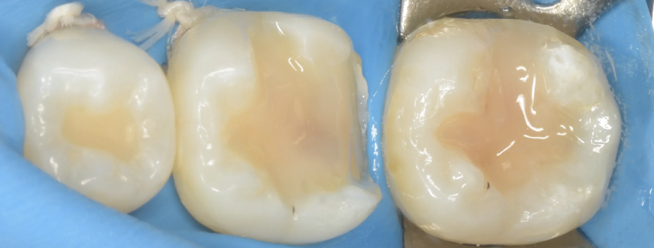 歯科医師の方のCAD/CAMインレーを治療。|坂寄歯科医院(取手市藤代) - 画像5