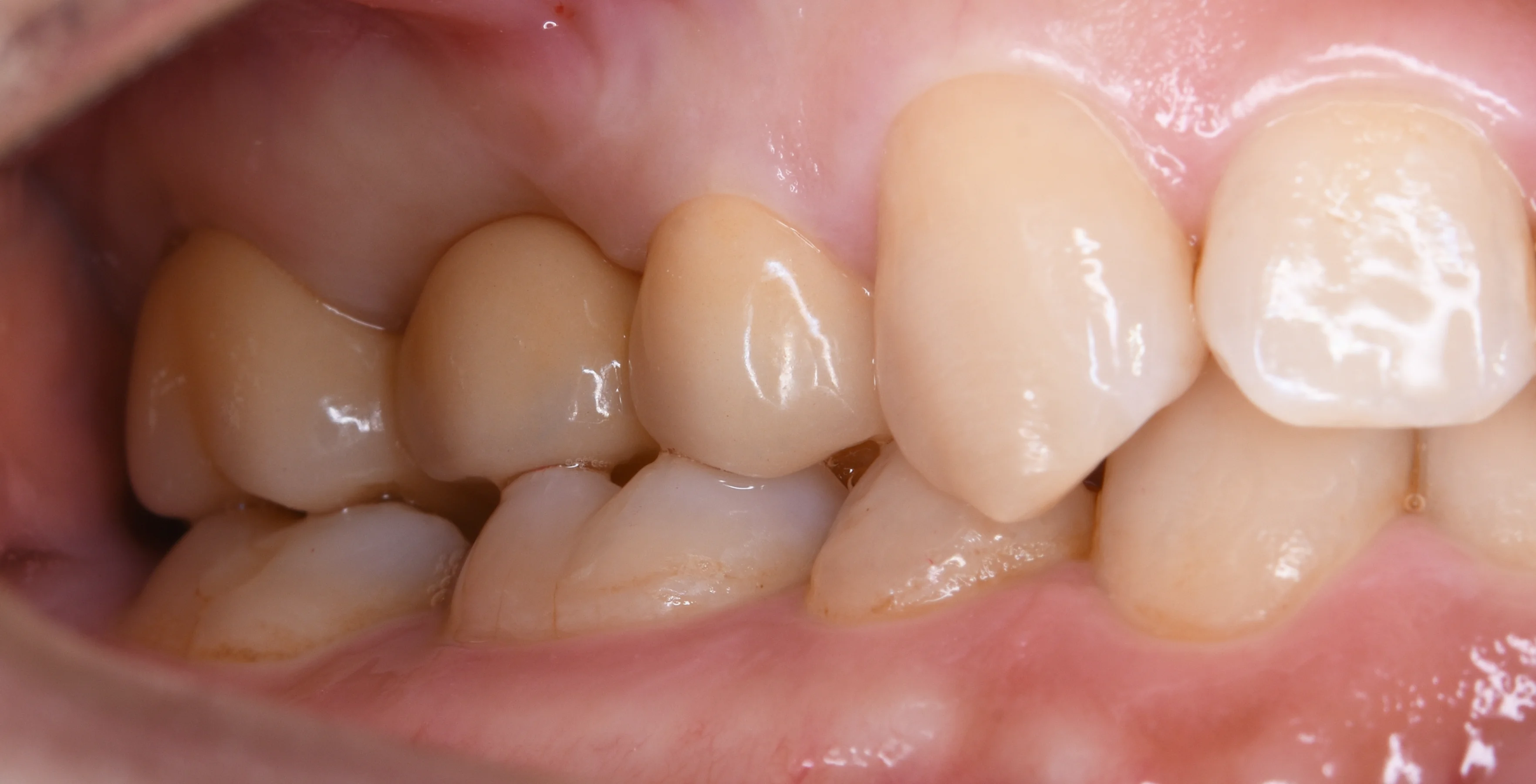 セラミックのブリッジ｜坂寄歯科医院（取手市藤代） - 画像2