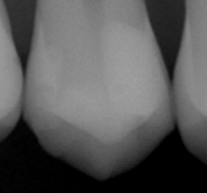 ダイレクトボンディングの長期経過｜坂寄歯科医院（取手市藤代） - 画像5
