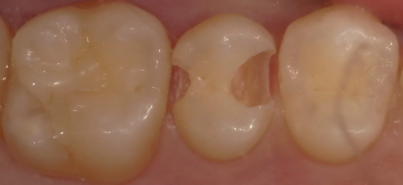 遠方から白い詰め物での治療を求めて・・・|坂寄歯科医院(取手市藤代) - 画像4