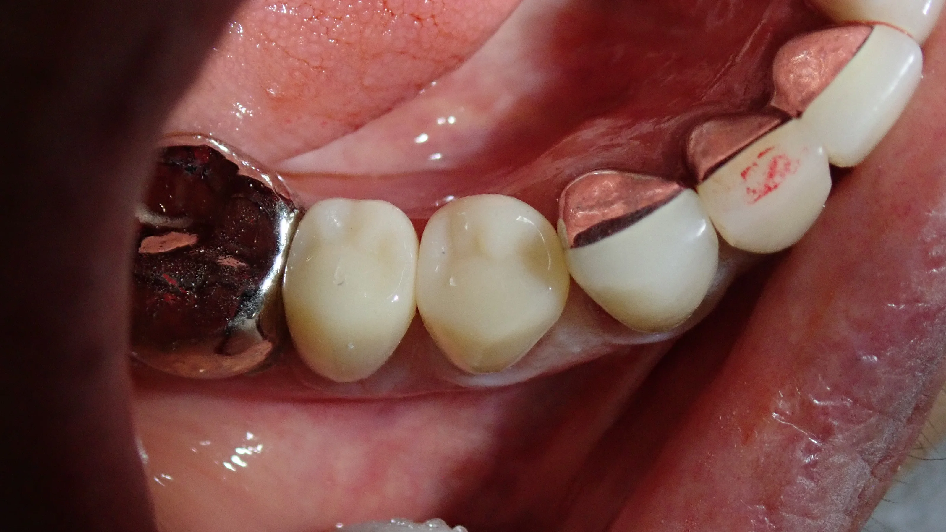 CAD/CAM冠について|坂寄歯科医院(取手市藤代) - 画像3