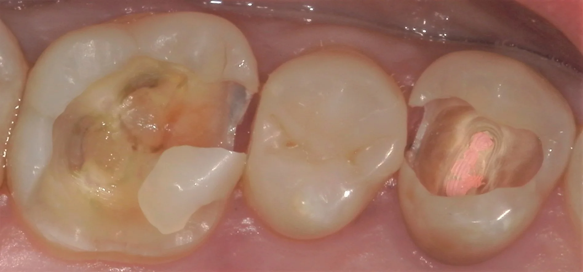 遠方から来院の方を白い詰め物にて治療。|坂寄歯科医院(取手市藤代) - 画像6