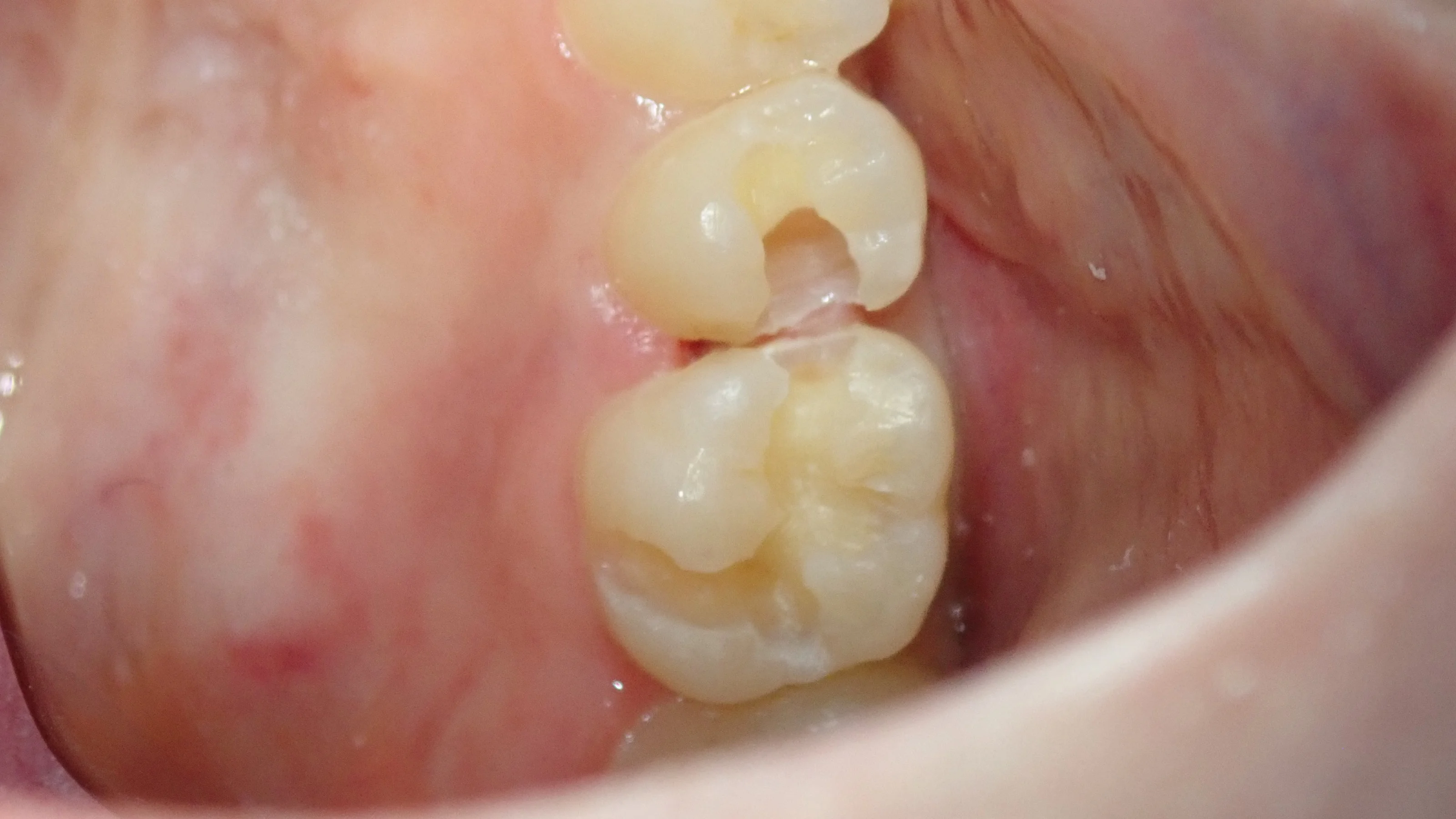 コンポジットレジン②｜坂寄歯科医院（取手市藤代） - 画像3