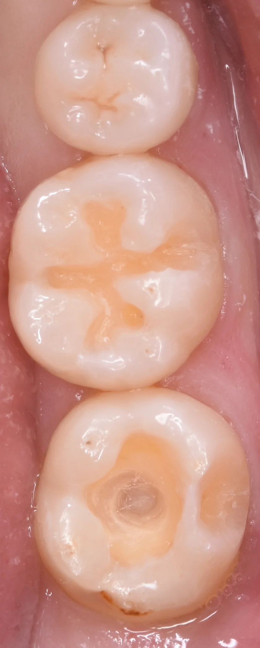 他県にて勤務中の歯科衛生士の方の治療。|坂寄歯科医院(取手市藤代) - 画像3