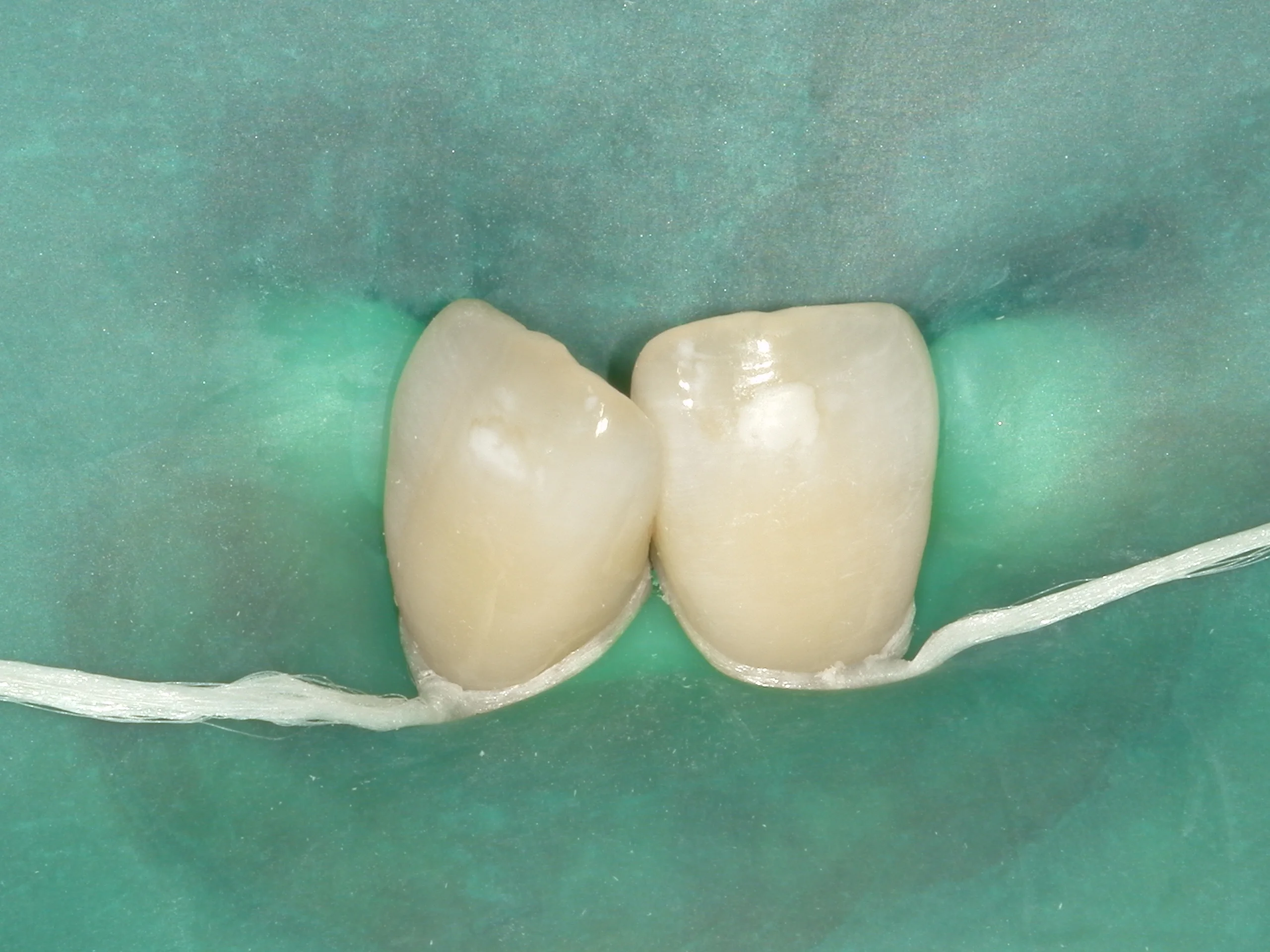 ICON治療(低侵襲ホワイトスポット改善治療)を始めました。｜坂寄歯科医院（取手市藤代） - 画像3