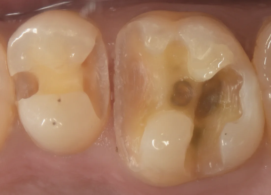 金属の詰め物を白い詰め物に。|坂寄歯科医院(取手市藤代) - 画像2