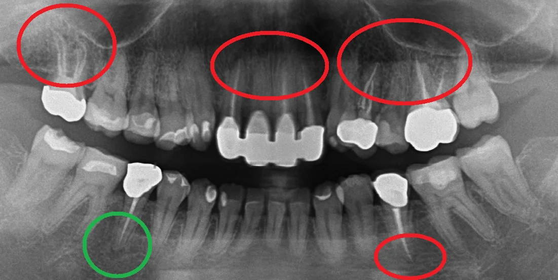 根管治療の成功率について|坂寄歯科医院(取手市藤代) - 画像2