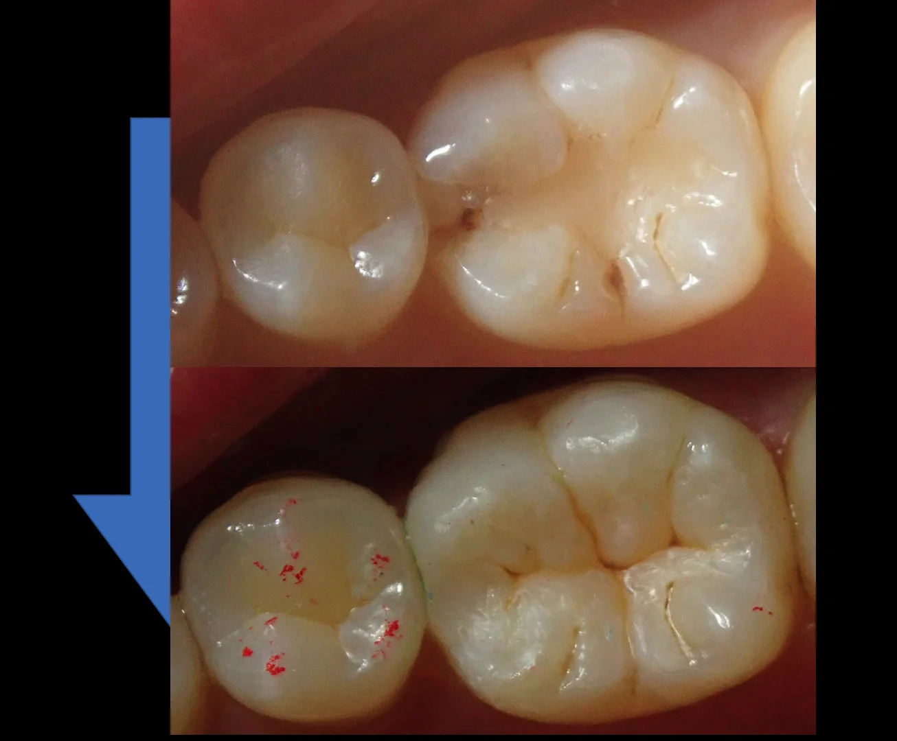ダイレクトボンディングの長期経過｜坂寄歯科医院（取手市藤代） - 画像6