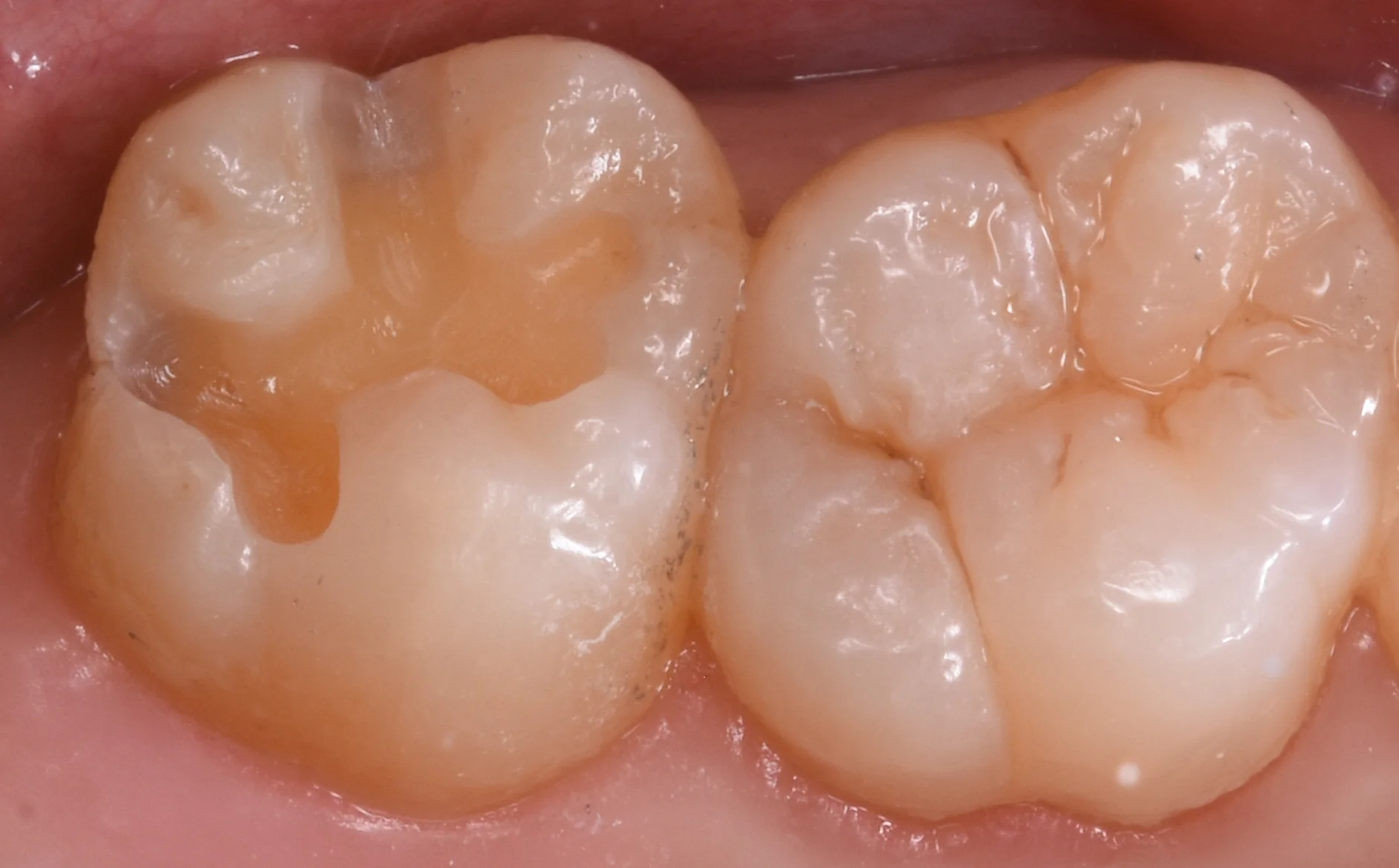 上の奥歯を金属から白い詰め物に。|坂寄歯科医院(取手市藤代) - 画像2