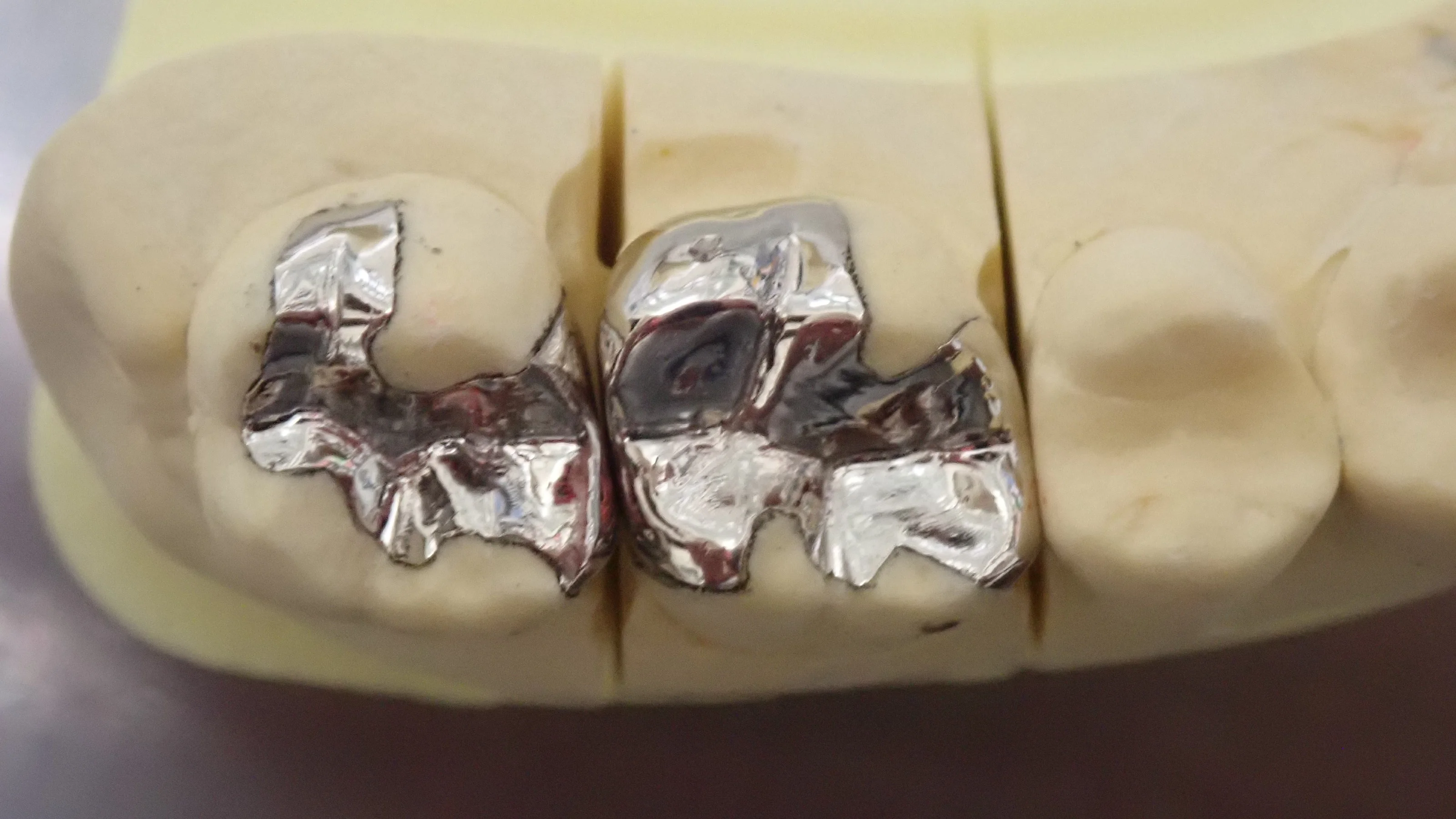 メタルインレー|坂寄歯科医院(取手市藤代) - 画像2