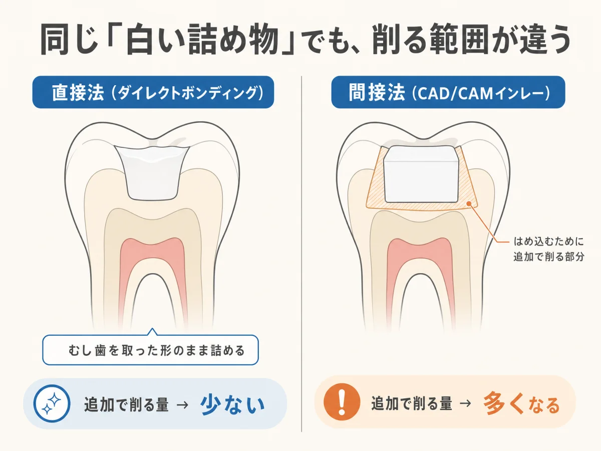 保険の白い詰め物（CAD/CAMインレー）を入れて後悔する前に