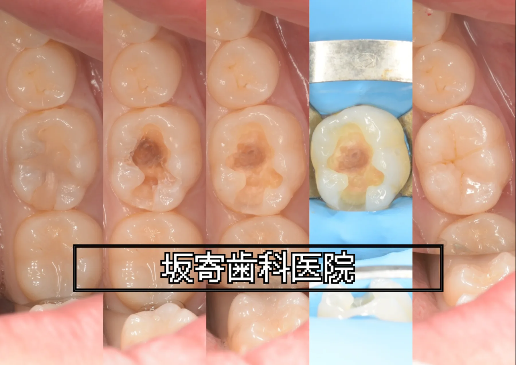 左下6番 詰め物の下の二次う蝕をダイレクトボンディングで再修復