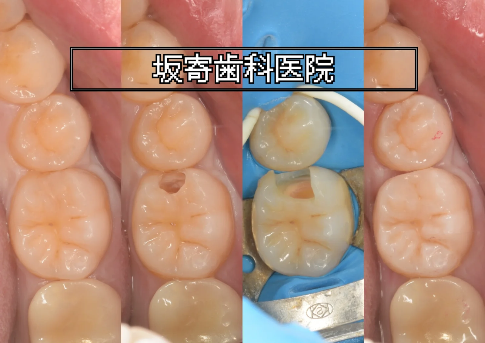 左下6番(下顎左第一大臼歯)近心の詰め物の下に広がっていたむし歯をダイレクトボンディングで修復した症例(術前・う蝕の明示・う蝕除去とラバーダム防湿・術後)の口腔内写真コラージュ|坂寄歯科医院