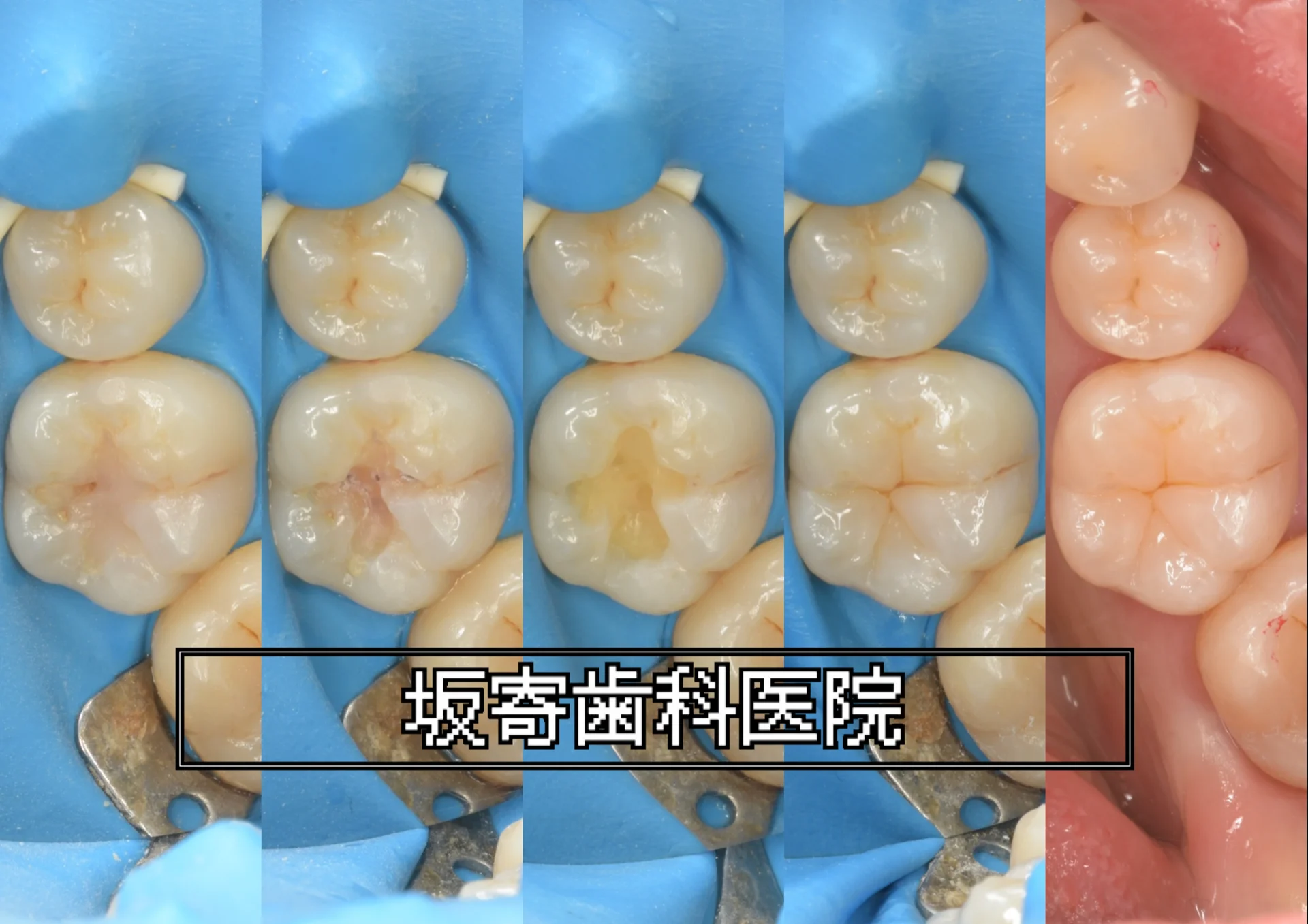 左下6番 旧CR欠け＋裂溝最深部からの二次う蝕に対するダイレクトボンディング再修復症例（術前／旧CR除去後／う蝕除去後／充填直後／咬合調整・研磨後）の口腔内写真5枚並びコラージュ｜坂寄歯科医院