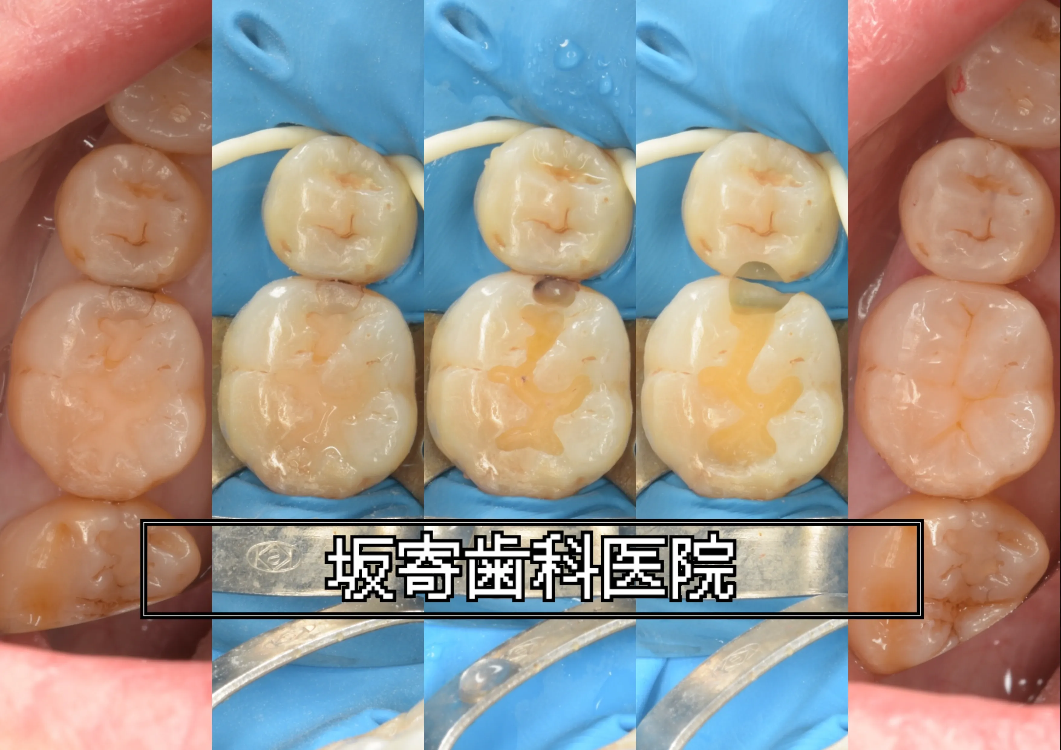 右下5番・6番に対するダイレクトボンディング2歯同日修復症例（術前咬合面観／ラバーダム防湿下の窩洞・隔壁形成／充填・形態回復／研磨完了）の写真コラージュ｜坂寄歯科医院