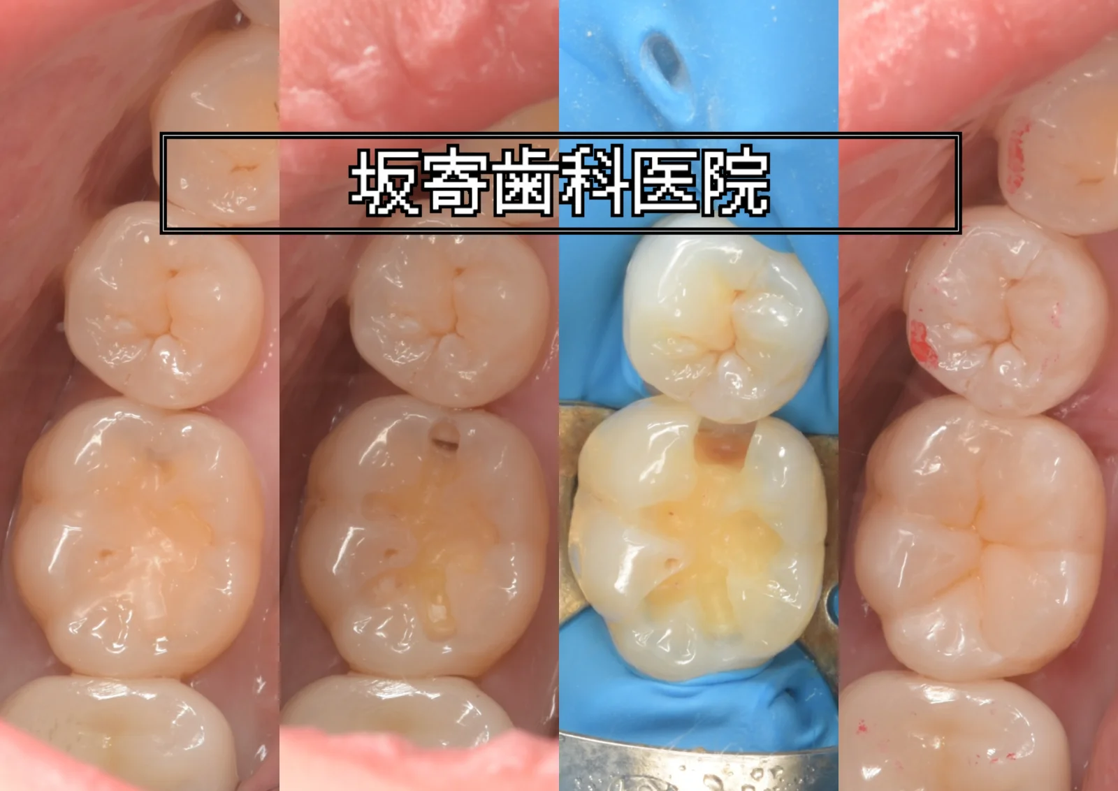 右下6番(下顎右第一大臼歯)近心のむし歯をダイレクトボンディングで修復した症例(術前・う蝕の範囲の明示・ラバーダム防湿後・術後)の口腔内写真コラージュ|坂寄歯科医院