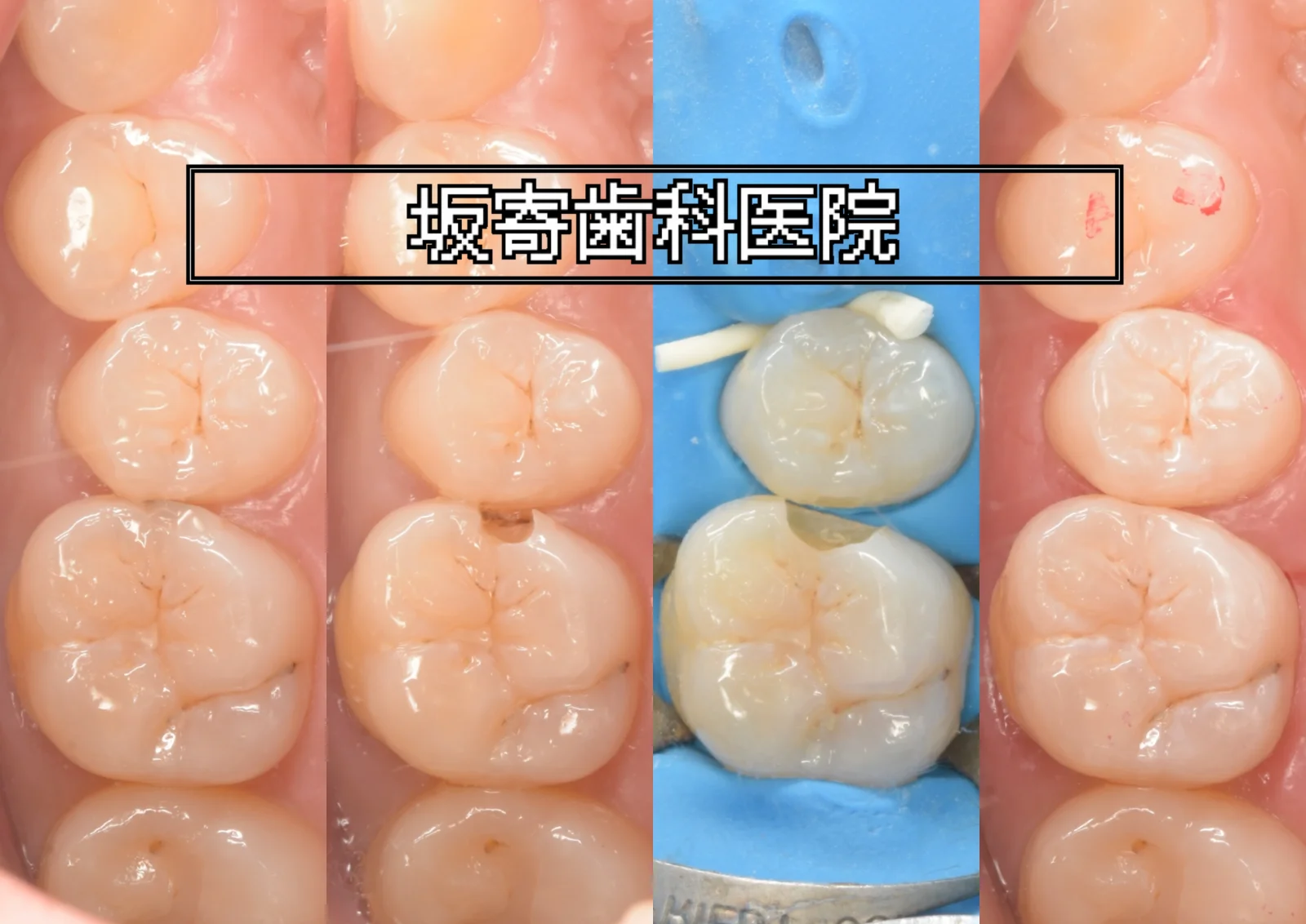 左上6番の古い詰め物の下のむし歯と左上5番をダイレクトボンディングで修復