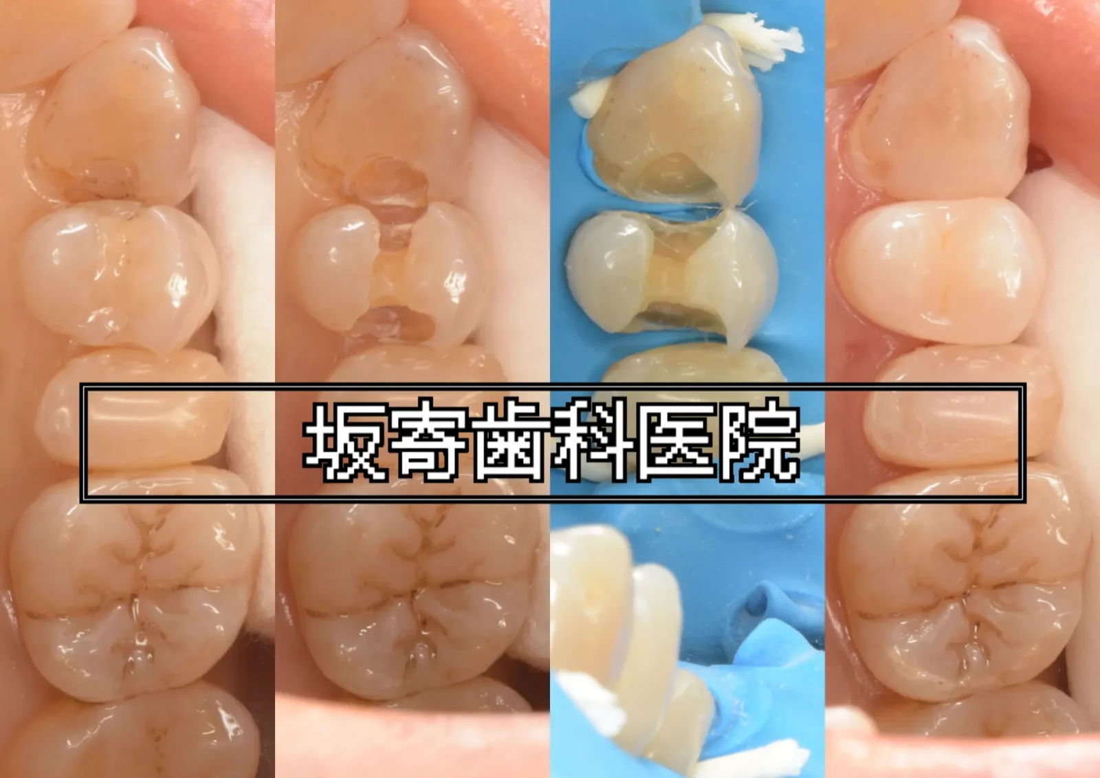 右上3番・4番 CR周囲二次う蝕のダイレクトボンディング再修復症例（術前／う蝕・旧CR除去後／ラバーダム防湿＋ダイヤモンドウェッジ・テフロンテープ適用下での充填／咬合調整・研磨後）の写真コラージュ｜坂寄歯科医院
