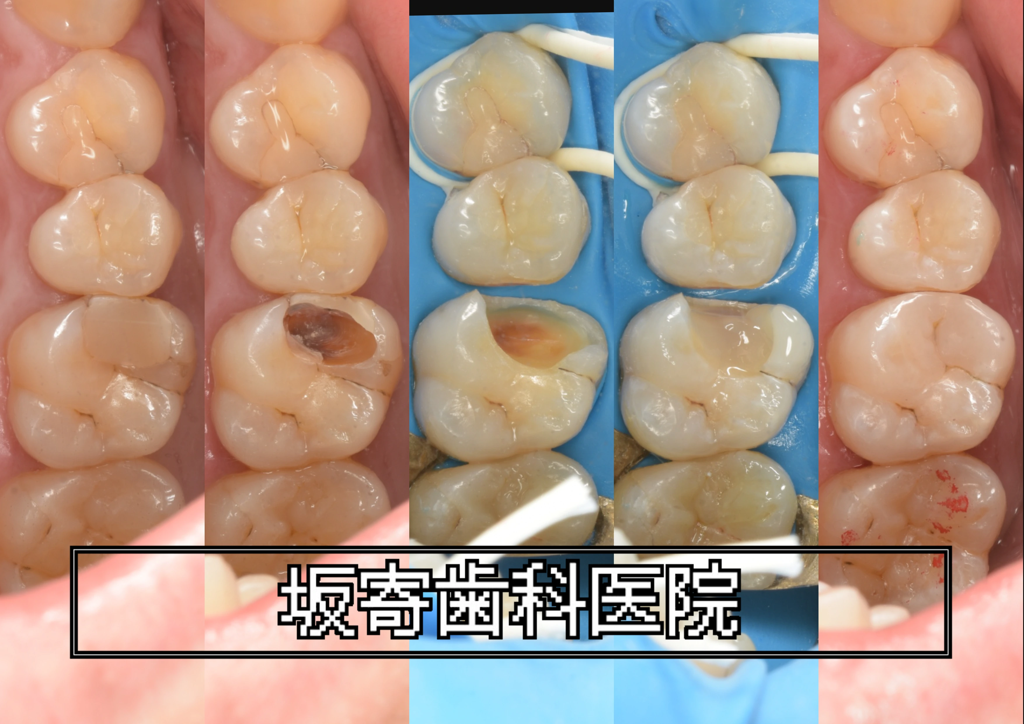 右上6番 遠心頬側 二次う蝕とクラックのダイレクトボンディング修復症例（術前・う蝕除去・ラバーダム防湿下充填・研磨後）の写真コラージュ｜坂寄歯科医院