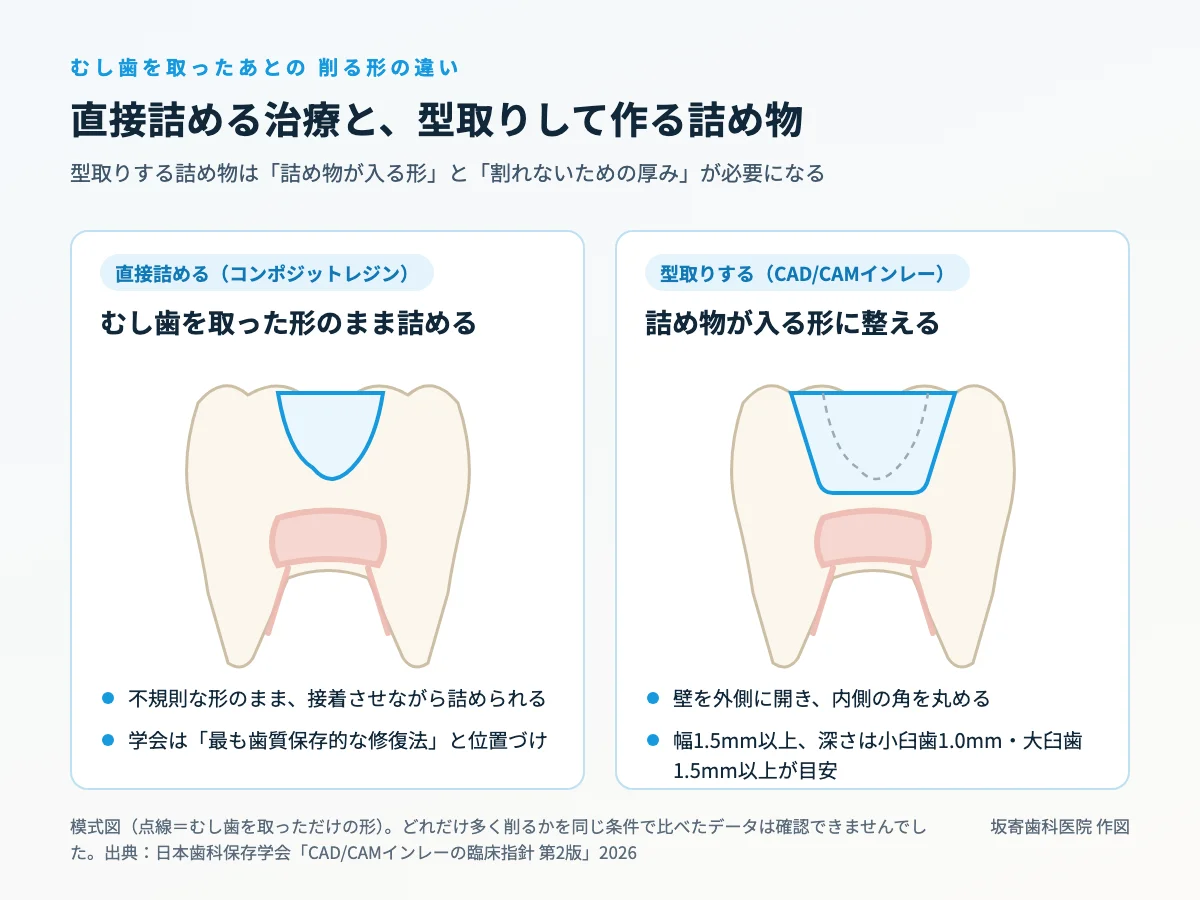 直接詰める治療と型取りして作る詰め物の削る形の違いを示した模式図。直接詰める治療はむし歯を取った不規則な形のまま詰め、型取りする詰め物は壁を外側に開き角を丸めた箱形に整える｜取手市藤代の坂寄歯科医院