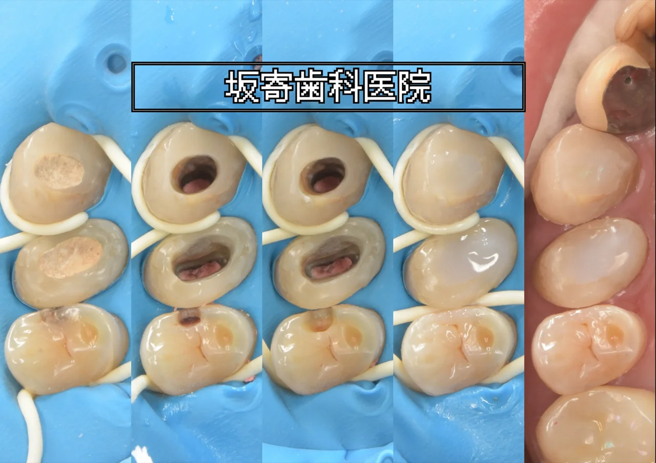 ラバーダム防湿下でレジン築造とダイレクトボンディング