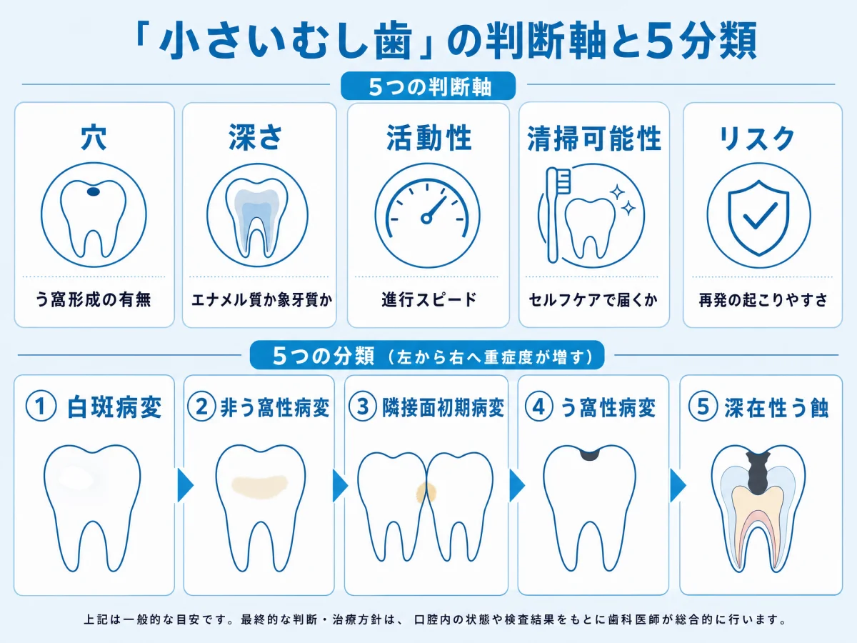 「小さいむし歯」を判断する5つの軸（穴・深さ・活動性・清掃可能性・リスク）と、白斑病変・非う窩性病変・隣接面初期病変・う窩性病変・深在性う蝕の5分類を、それぞれの特徴とともに整理したインフォグラフィック｜取手市藤代の坂寄歯科医院